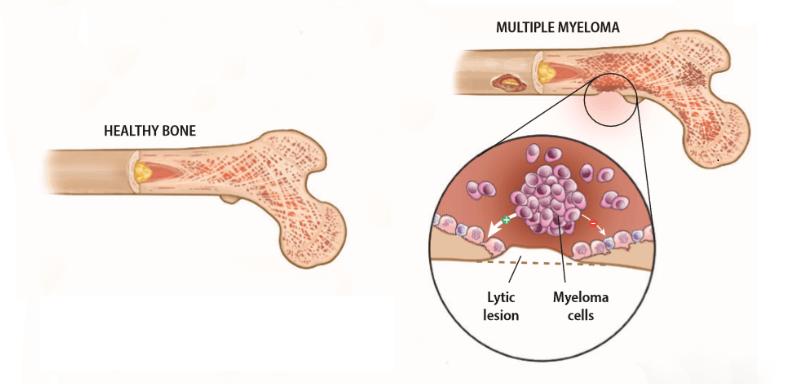 Triệu chứng và phương pháp điều trị bệnh đau tủy Myeloma
